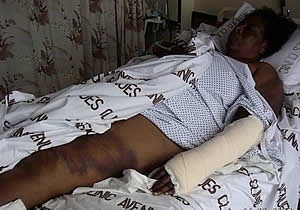 Sekai Holland - photo shows injuries to her left arm and leg