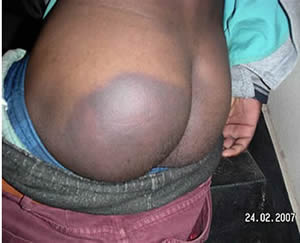 This photograph was emailed to Kubatana illustrating injuries sustained by Movement for Democratic Change supporters at the rally in Highfield in Harare which was disrupted by the Zimbabwe Republic Police. 