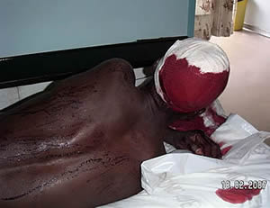 This photograph was emailed to Kubatana illustrating injuries sustained by Movement for Democratic Change supporters at the rally in Highfield in Harare which was disrupted by the Zimbabwe Republic Police. 