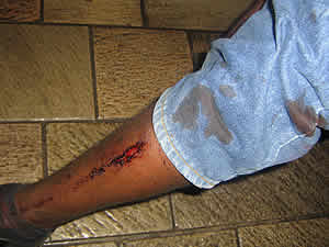 Injuries sustained by Highfield residents after the Zimbabwe Republic Police blocked a prayer meeting at the Zimbabwe Grounds in Highfield