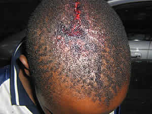 Injuries sustained by Highfield residents after the Zimbabwe Republic Police blocked a prayer meeting at the Zimbabwe Grounds in Highfield