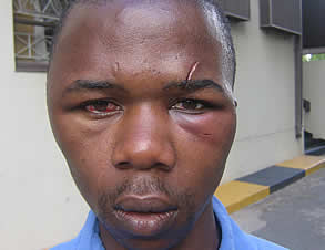 Injuries sustained by Highfield residents after the Zimbabwe Republic Police blocked a prayer meeting at the Zimbabwe Grounds in Highfield