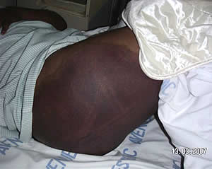 Grace Kwinjeh - Right buttock