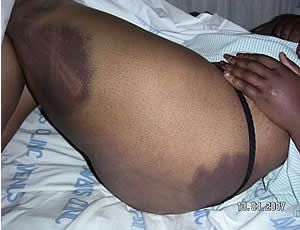 Grace Kwinjeh - left buttock and leg