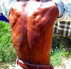 Man's back with welts from beating