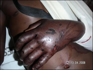 Reprisal attacks against voters in Zimbabwe