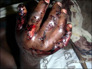 Reprisal attacks against voters in Zimbabwe