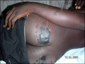 Reprisal attacks against voters in Zimbabwe