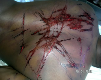 Man's back with wounds from chains and fan belts