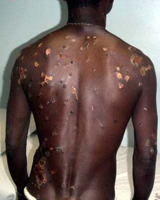 Man's back showing plastic burns