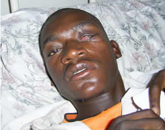 Daniel Simango, stabbed in the eye