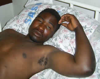 Man's back showing plastic burns