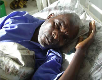 Man's back showing plastic burns