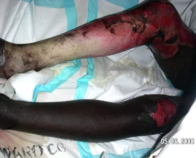 Burnt legs