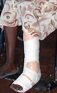 This woman, in her sixties said she was beaten by the police whilst lying on the ground. Doctors are attempting to save her leg. Her condition remains critical. 