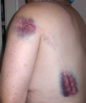 Beaten back and arm